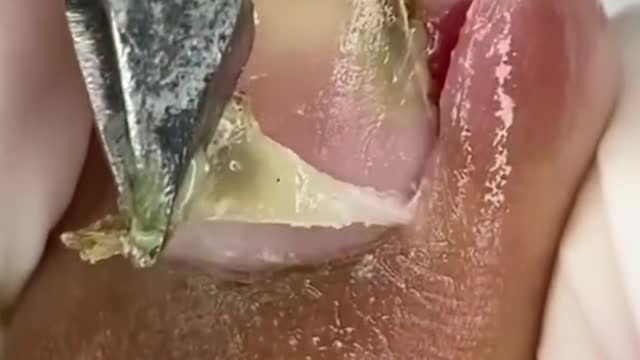 Painful Toenail ingrown removal #1