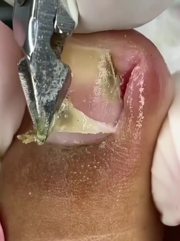 Painful Toenail ingrown removal #1