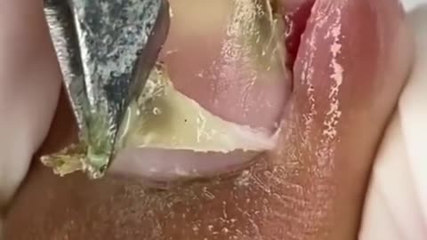 Painful Toenail ingrown removal #1