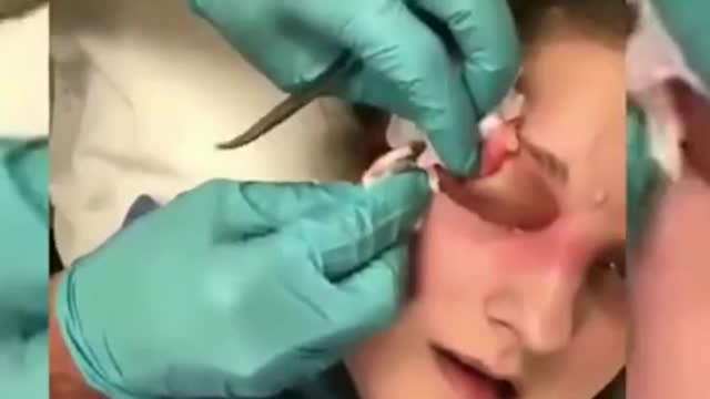 Satisfying Pimple Popping Video Compilation