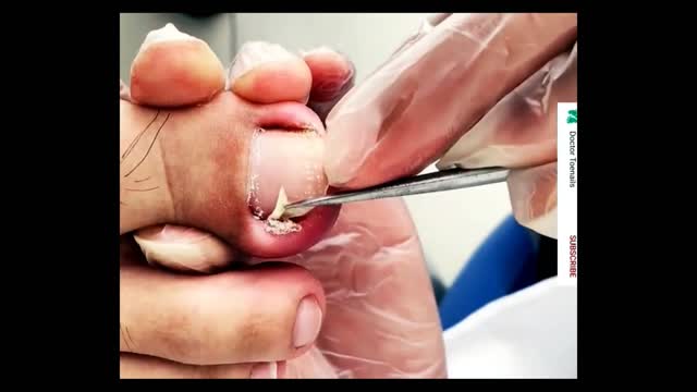 VERY PAINFUL Toenail ingrown removal!!!!