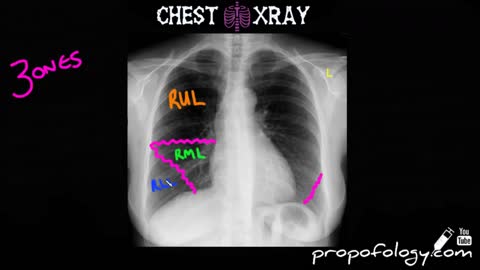 how to read chest x ray