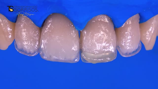 Os Segredos do Translúcido Incisal