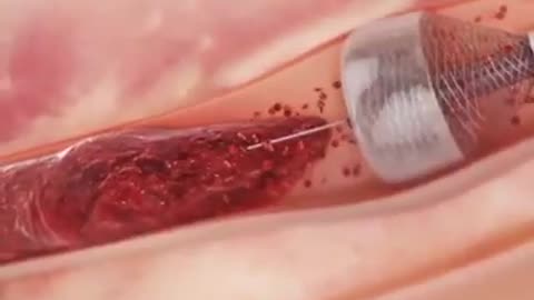 Megavace thrombectomy