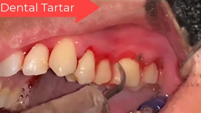 Tartar Dentist 2021 | Satisfying Dental-work