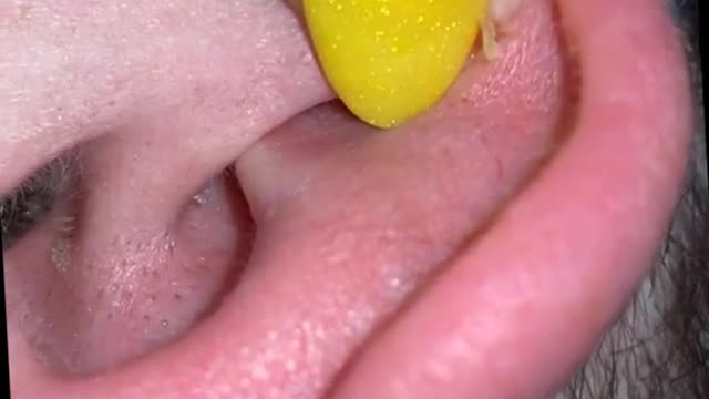 Blackhead Removal - Pimple popping - Acne Treatment - 09 #shorts