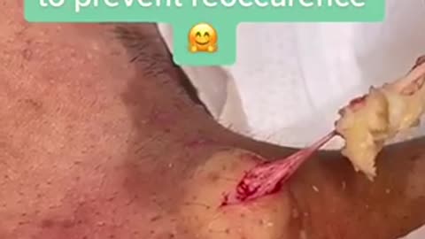 Removal of acne