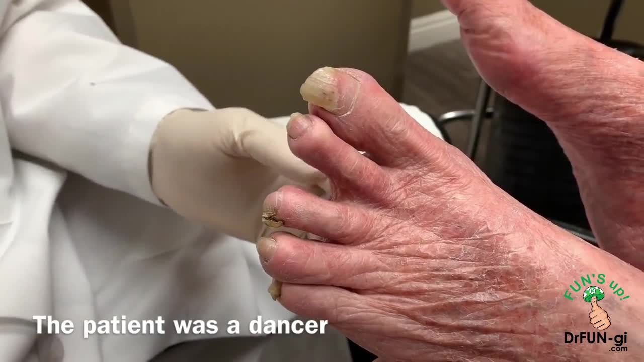 1 YEAR WITHOUT BEING CUT! 96-Year-Old Patient's Toenails