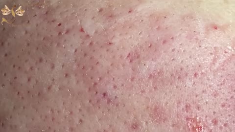 #152 | Acne Treatment Huong beauty - Part 1