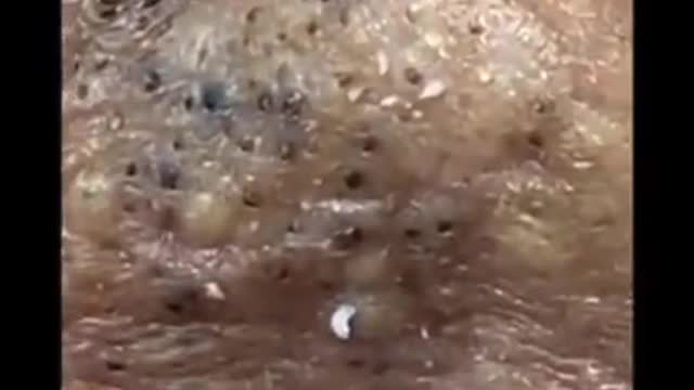 How to remove blackheads from nose, pop pimples, acne treatment #75 #shorts