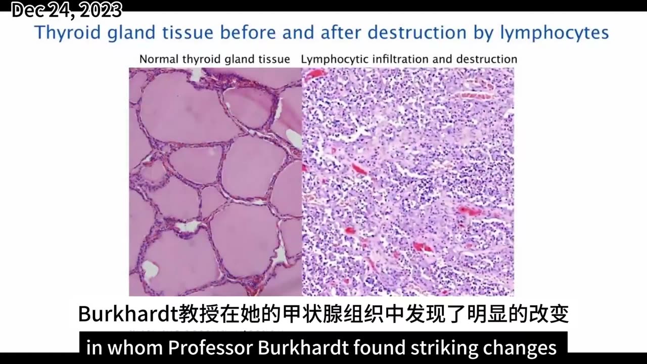 Burkhardt 教授解释接种疫苗后大量心脏、肺脏和甲状腺异常