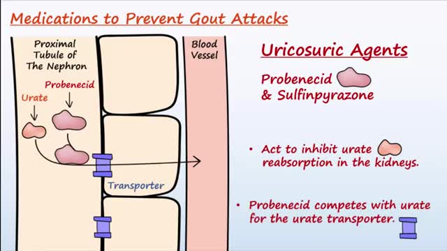 Chronic Gout Treatment - The Second Phase of Treating Gout -6 of 6-