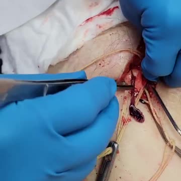 Dr Richard - Coágulos en VACUNADOS ‼️ 83% de sus pacientes les ocurre esto