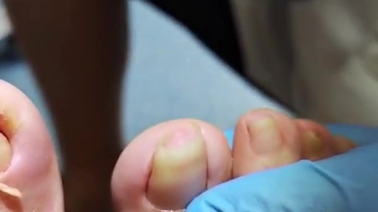 Top Removing & Cutting Old & Long Large Ingrown Toenails Art 👣Toenail Roomb