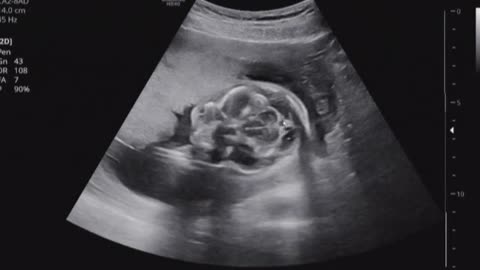 Baby ultrasound image and sound (3)