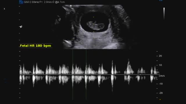 Ultrasound imaging of pregnant women