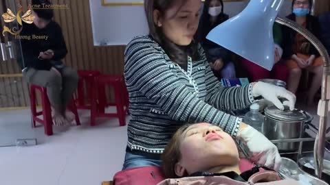 #211 | Acne Treatment Huong beauty