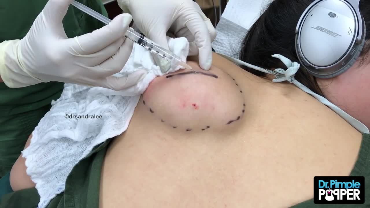 Part 1- A Pancake-Sized Lipoma on the Back with Dr Pimple Popper