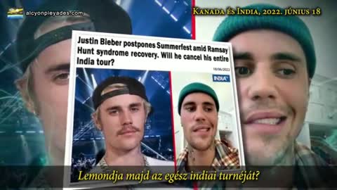 Justin Bieber énekes arcbénulást szenved a Covid-vakcina miatt