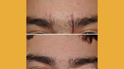 Before & After Cosmetic Treatments - Canada MedLaser Clinic