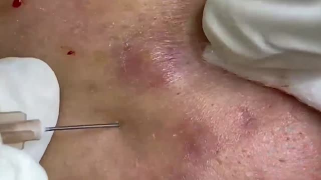 Giants Deep Blackheads, Whiteheads, Big Pimples, Hidden Acne Removal - Best Popping Videos #000041