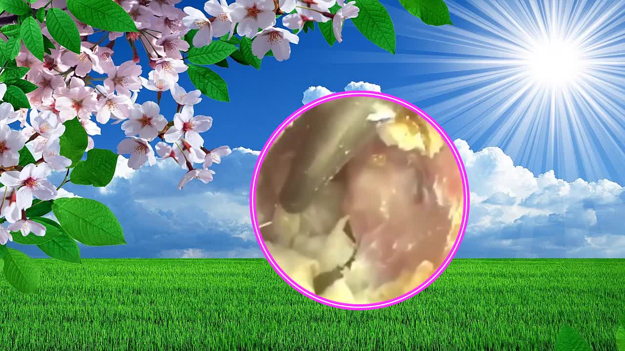Cholesteatoma Earwax Removal #18