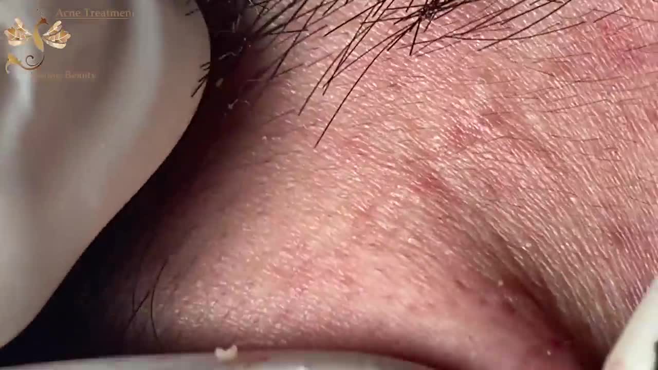 # 237 Acne Treatment Huong beauty