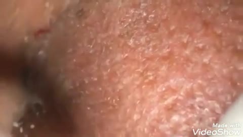 Big Cystic Acne Blackheads Extraction Blackheads