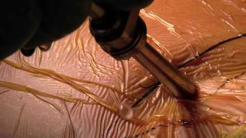 Douglas Linville, M.D. - Transforaminal Endoscopic Microdiscectomy