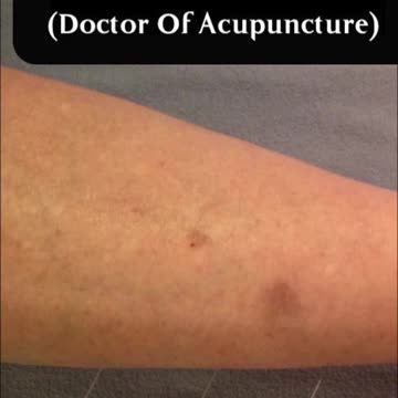 what to do when local acupuncture needling does not work?