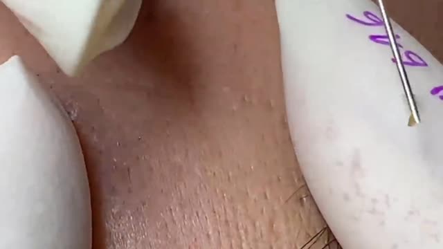 acne treatment#1