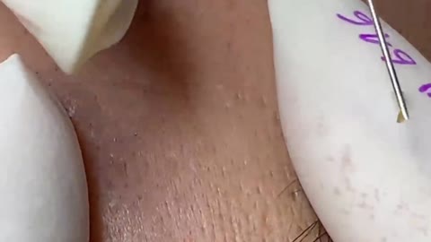 acne treatment#1