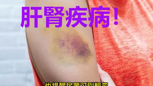 「不明瘀青」 肝腎疾病!