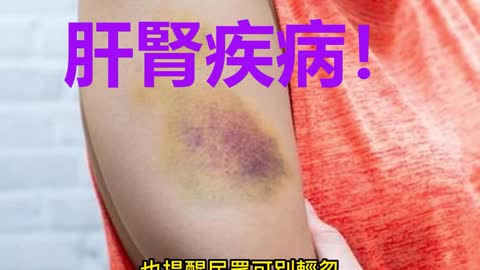 「不明瘀青」 肝腎疾病！