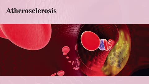 Atherosclerosis