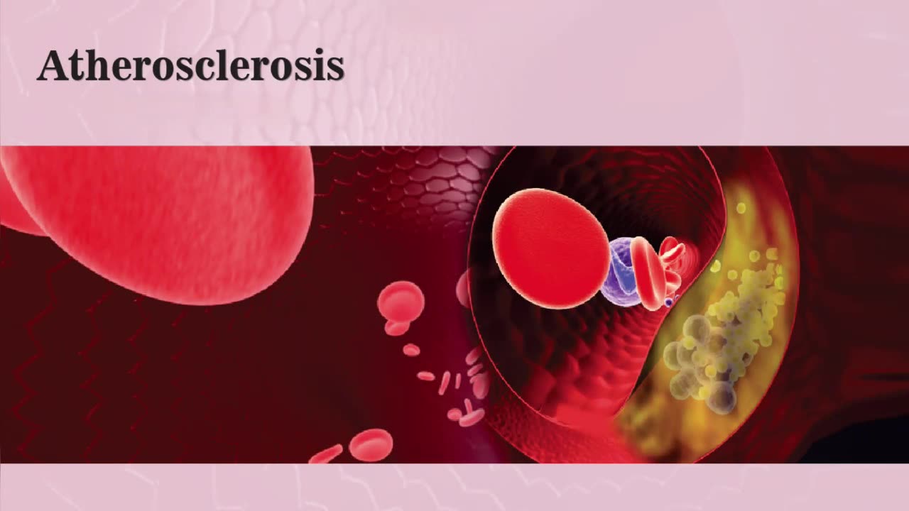 Atherosclerosis