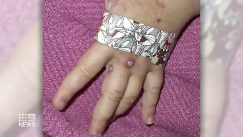 Monkeypox virus spreading in Melbourne | 9 News Australia