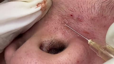 pimple,pimples,pimple pop,pimple popping,drpimplepopper,dr
