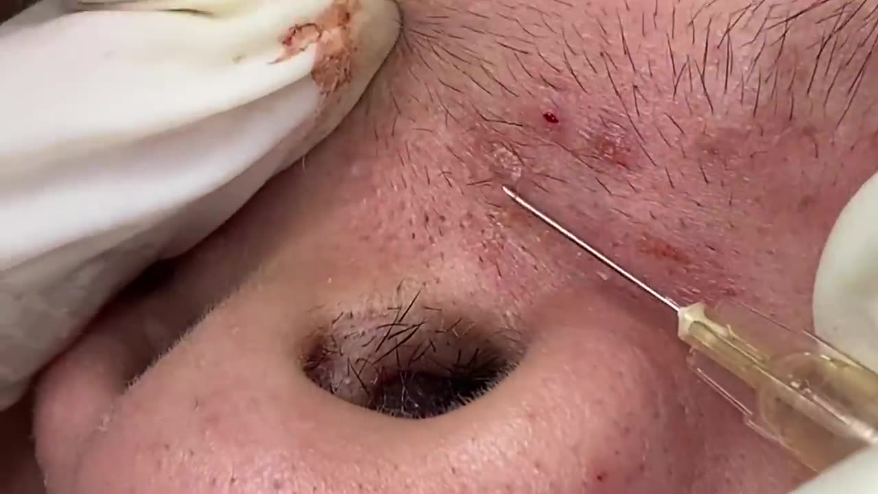 pimple,pimples,pimple pop,pimple popping,drpimplepopper,dr