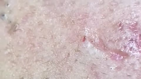 Blackheads & Milia, Big cystic acne blackheads extraction whiteheads Removal Pimple Popping.