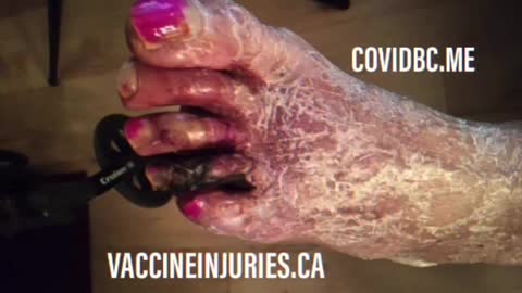 Vaccine-Induced Leg Amputation