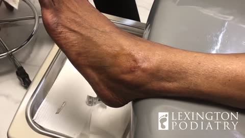Oozing Cyst
