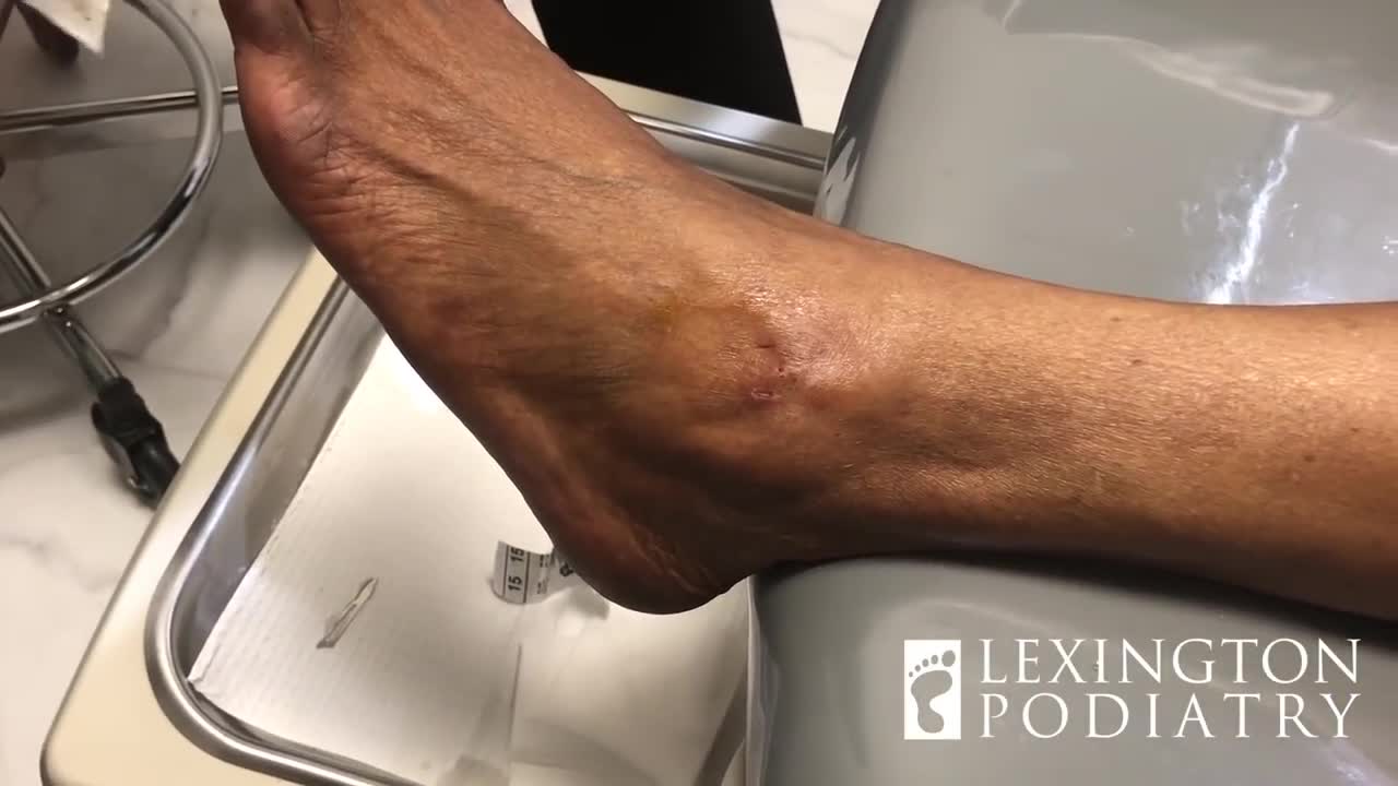 Oozing Cyst