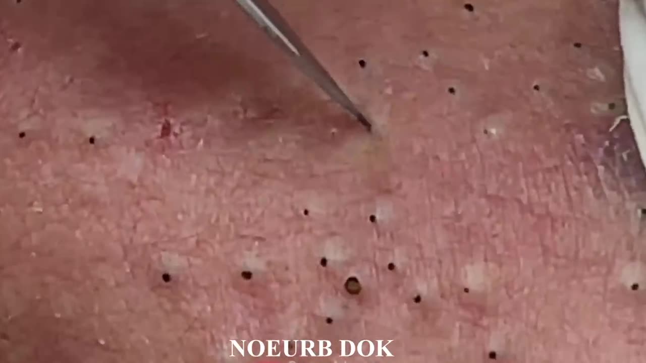 Popping Tons of Blackheads!