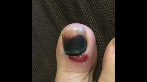 Ingrown toenails removal