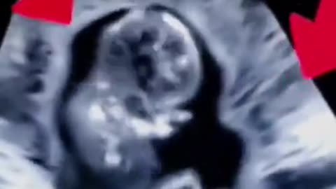 Bambino cerca di sfuggire al brutale aborto con smembramento