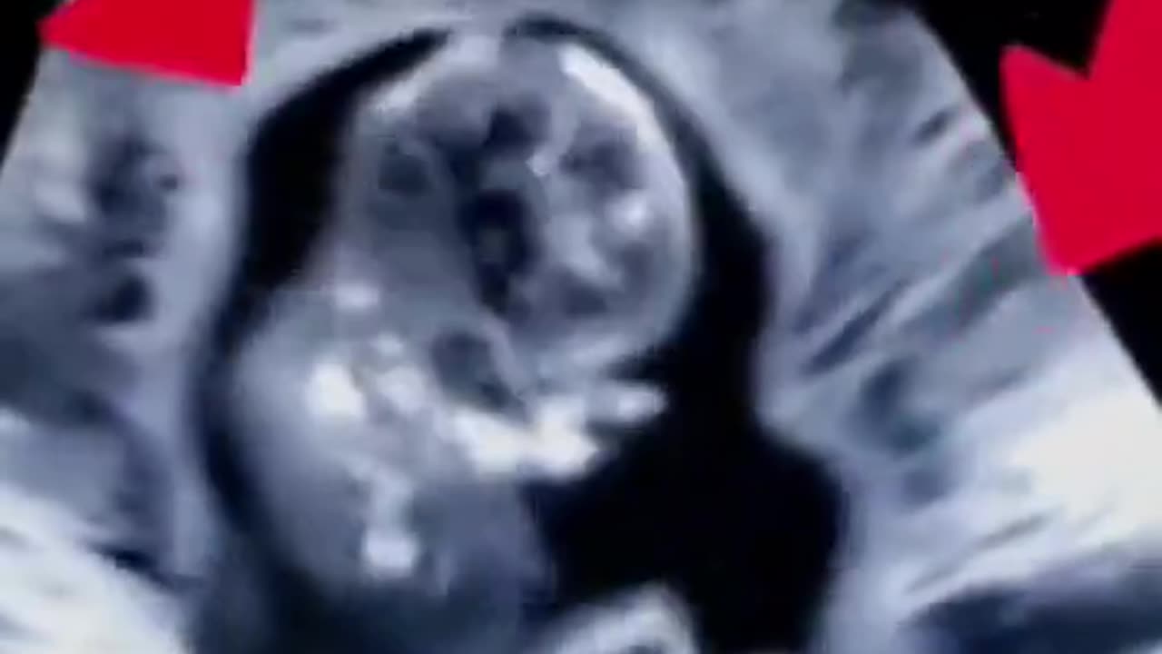 Bambino cerca di sfuggire al brutale aborto con smembramento