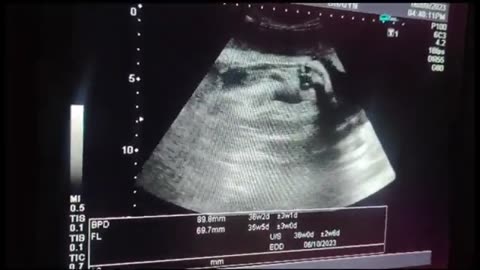 Male Gender At 35_36 Week With Leaking and Labor Pain😱😱😱