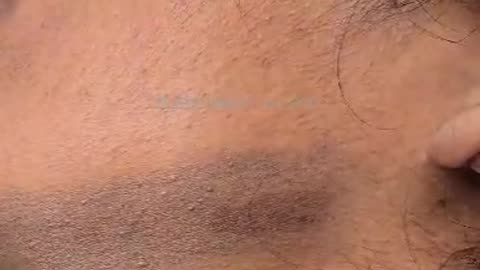 Revitalize Your Skin with Hollywood Laser Peel: The Ultimate Skin Health Treatment