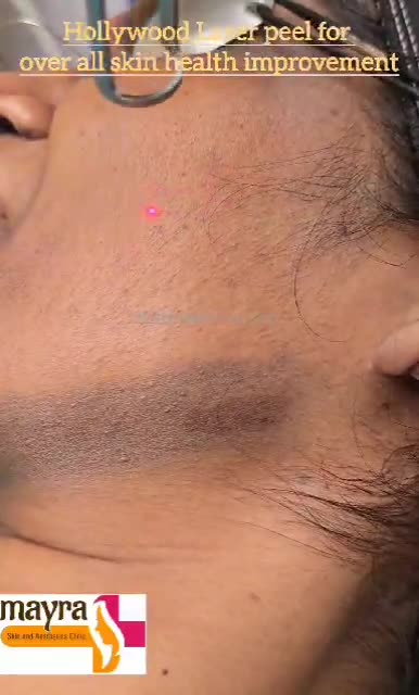 Revitalize Your Skin with Hollywood Laser Peel: The Ultimate Skin Health Treatment